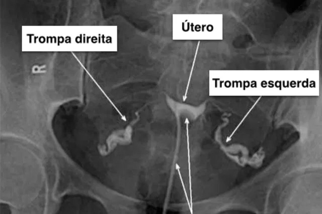 radiografia de útero e trompas