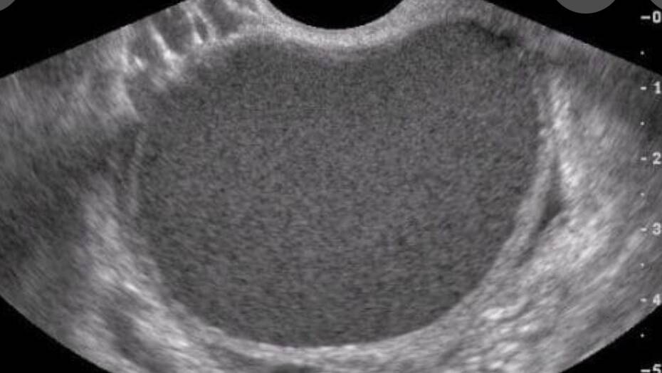 Ultrassonografia transvaginal mostrando endometrioma ovariano, cisto associado à endometriose.