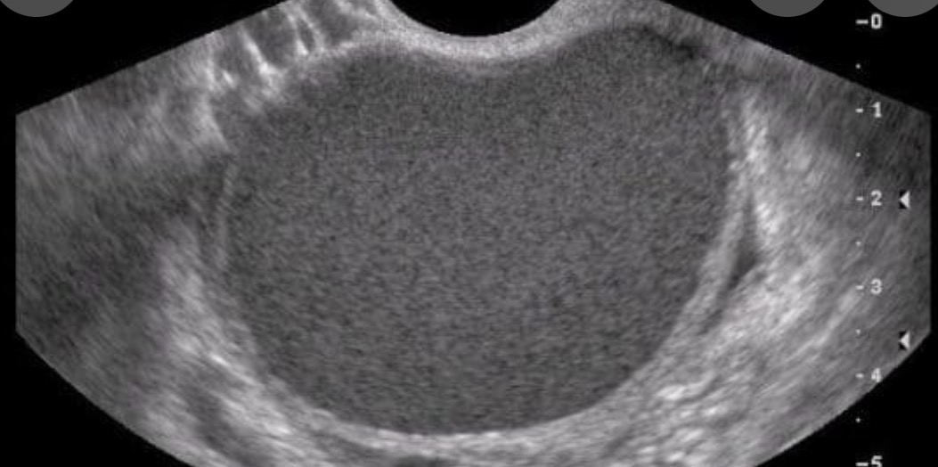 Ultrassonografia transvaginal mostrando endometrioma ovariano, cisto associado à endometriose.