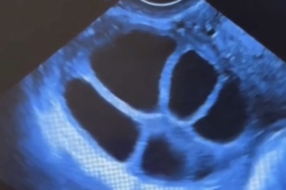 número de óvulos varia entre ciclos de FIV: Ultrassom ovariano mostrando folículos durante acompanhamento da estimulação