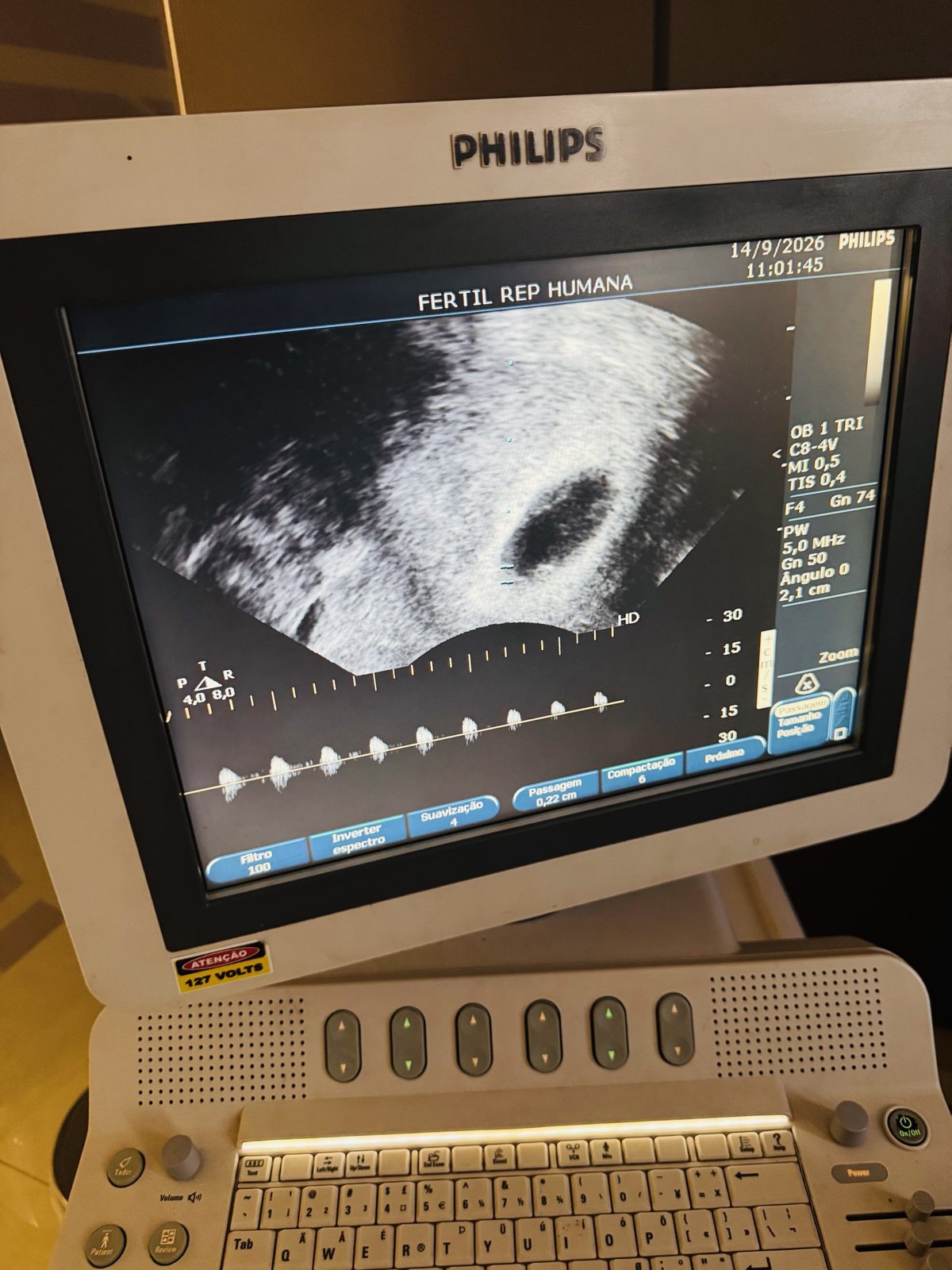 Ultrassom transvaginal com Doppler mostrando saco gestacional no início da gravidez, realizado na Fértil Reprodução Humana