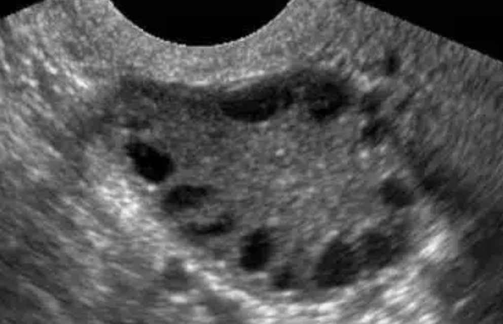 Ultrassom transvaginal de ovário em escala de cinza mostrando vários folículos pequenos, escuros e arredondados, dispostos na periferia do ovário